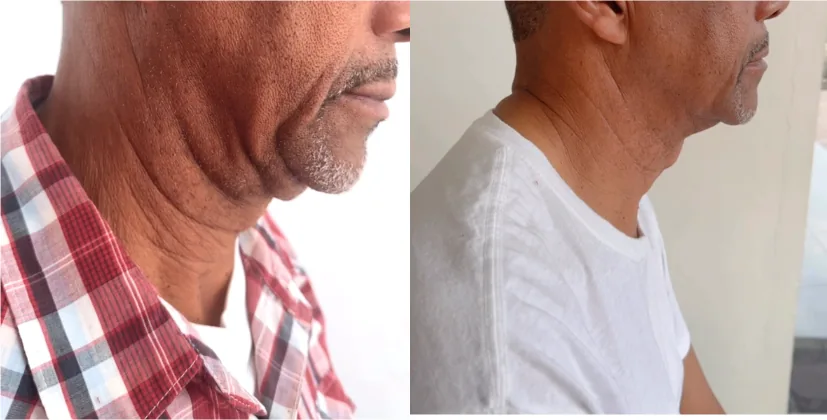 Resultado real cliente 2 - antes y después