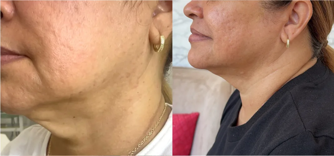 Resultado real cliente 4 - antes y después